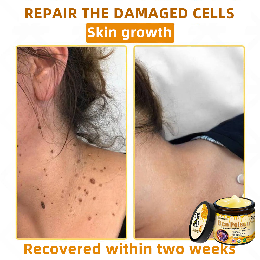 LOVILDS™ 🐝Bee Poison Skin Restoration Cream 🐝（🔥LAST DAY SALE-80% OFF)🥇👩‍⚕️ (Cópia)