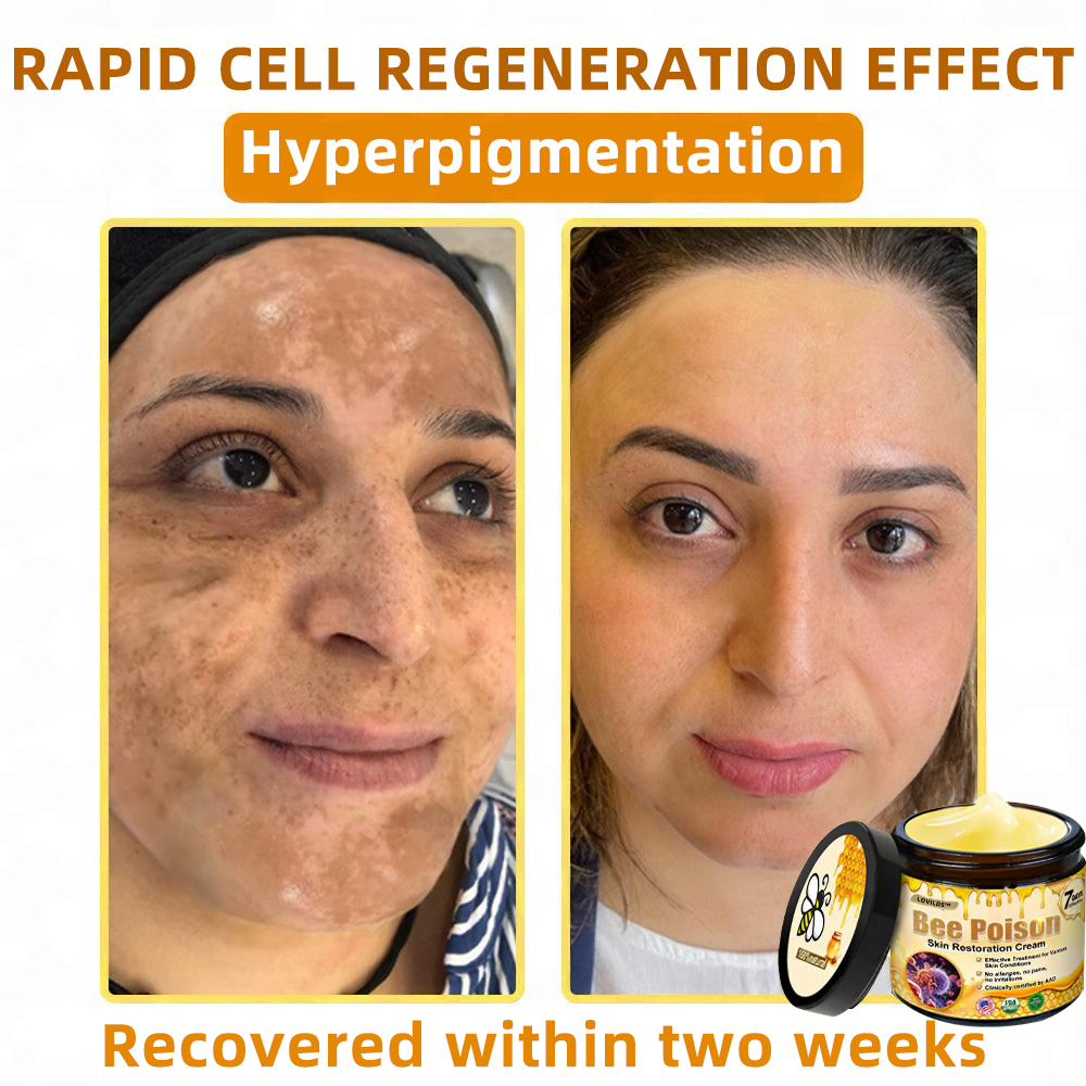 LOVILDS™ 🐝Bee Poison Skin Restoration Cream 🐝（🔥LAST DAY SALE-80% OFF)🥇👩‍⚕️ (Cópia)