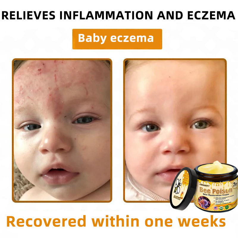 LOVILDS™ 🐝Bee Poison Skin Restoration Cream 🐝（🔥LAST DAY SALE-80% OFF)🥇👩‍⚕️ (Cópia)