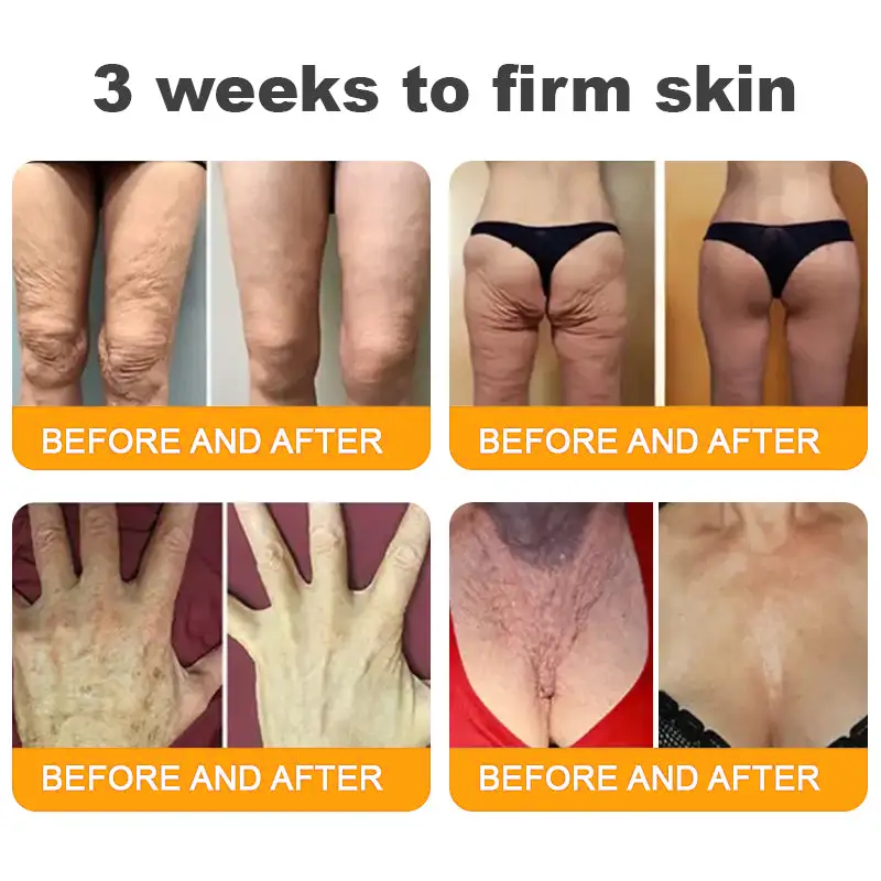 LOVILDS™ 🐝Bee Poison Skin Restoration Cream 🐝（🔥LAST DAY SALE-80% OFF)🥇👩‍⚕️ (Cópia)