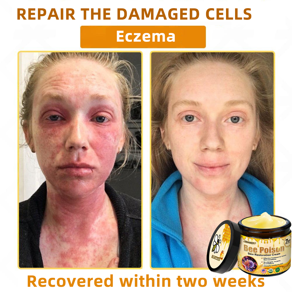 LOVILDS™ 🐝Bee Poison Skin Restoration Cream 🐝（🔥LAST DAY SALE-80% OFF)🥇👩‍⚕️ (Cópia)